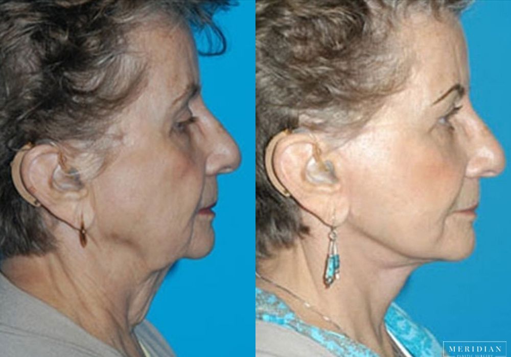 Facelift - Thumbnail 2