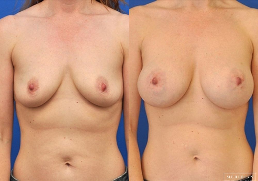 Breast Augmentation - Case 8034