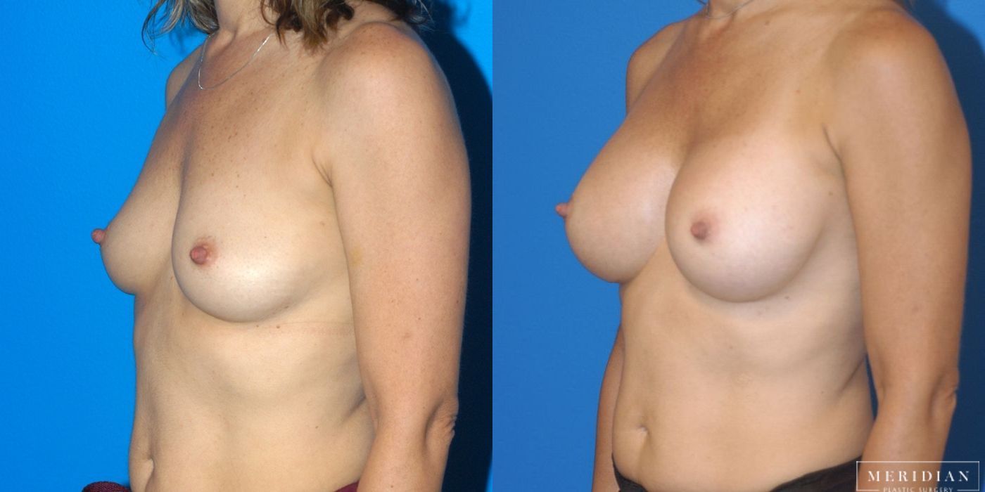 Breast Augmentation - Thumbnail 2