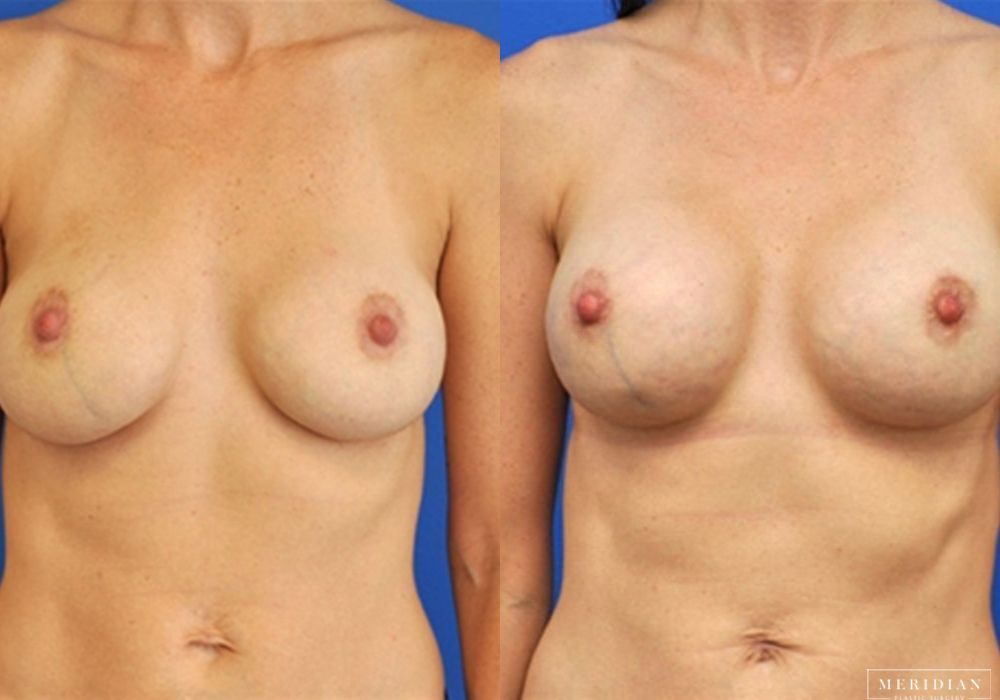 Breast Revision - Case 8082