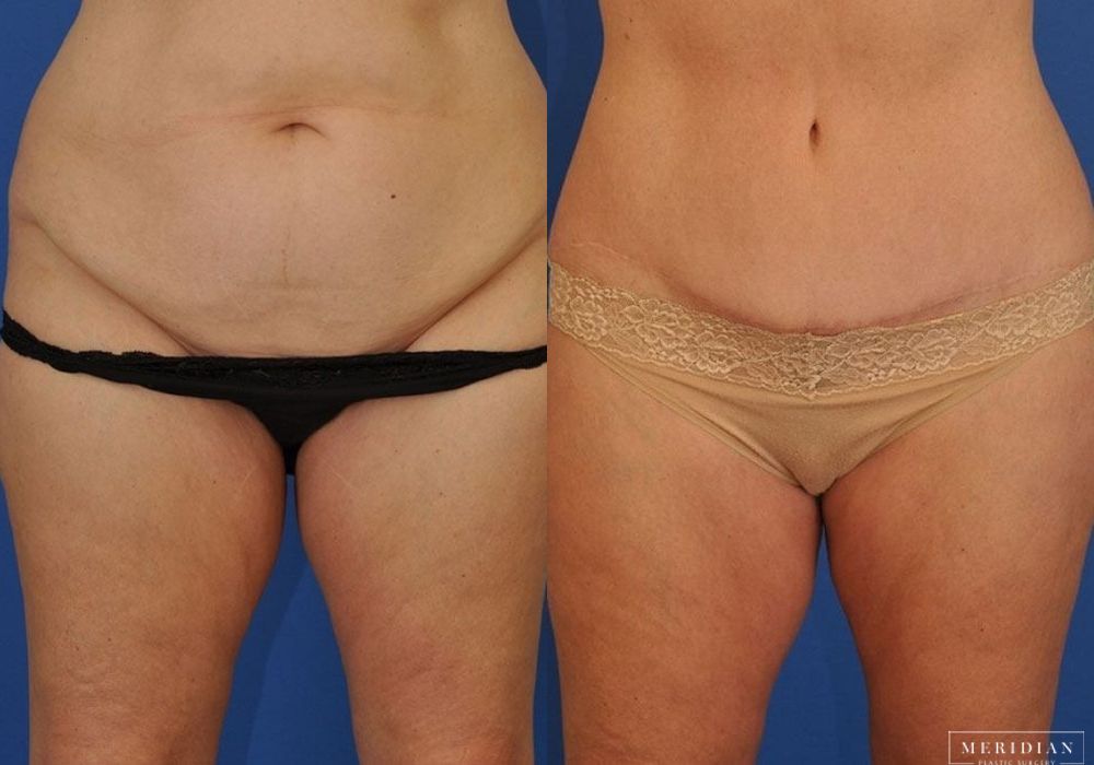 Body Contouring - Case 7987