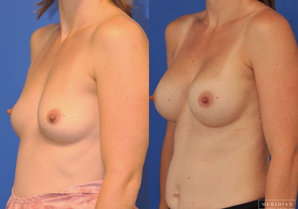 Breast Augmentation - Thumbnail 2