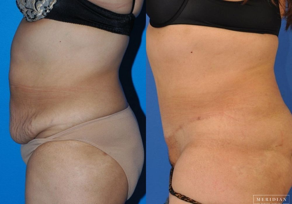 Tummy Tuck - Thumbnail 2