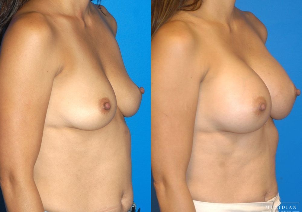 Breast Augmentation - Thumbnail 2