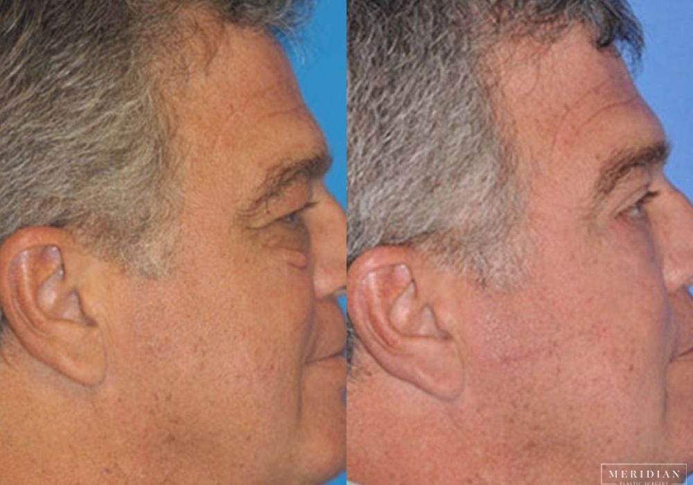 Eyelid Lift - Thumbnail 2