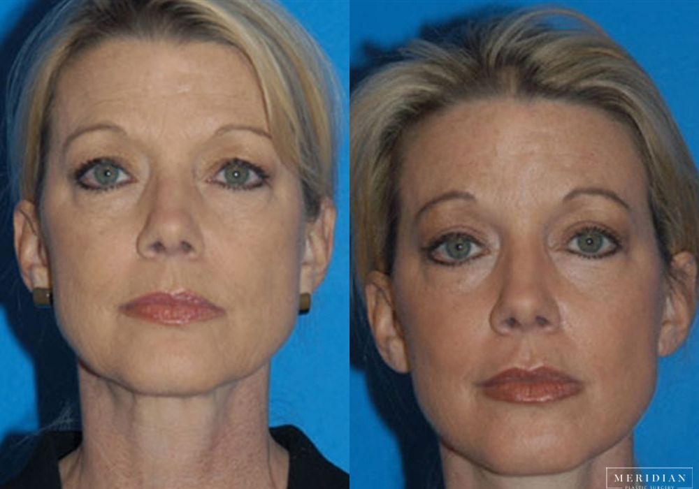 Facelift - Case 8116