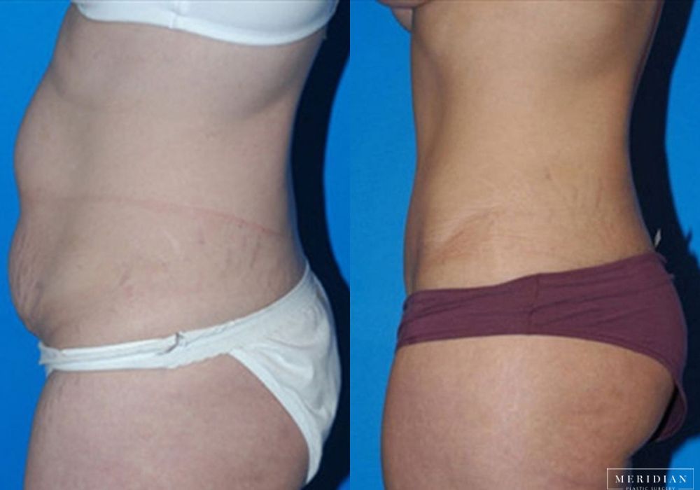 Tummy Tuck - Thumbnail 2
