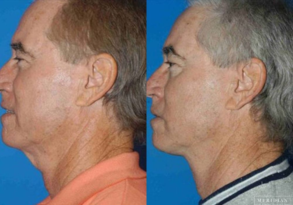 Neck Lift - Thumbnail 2