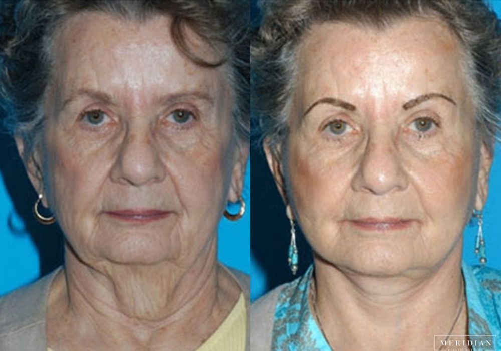 Facelift - Case 8115