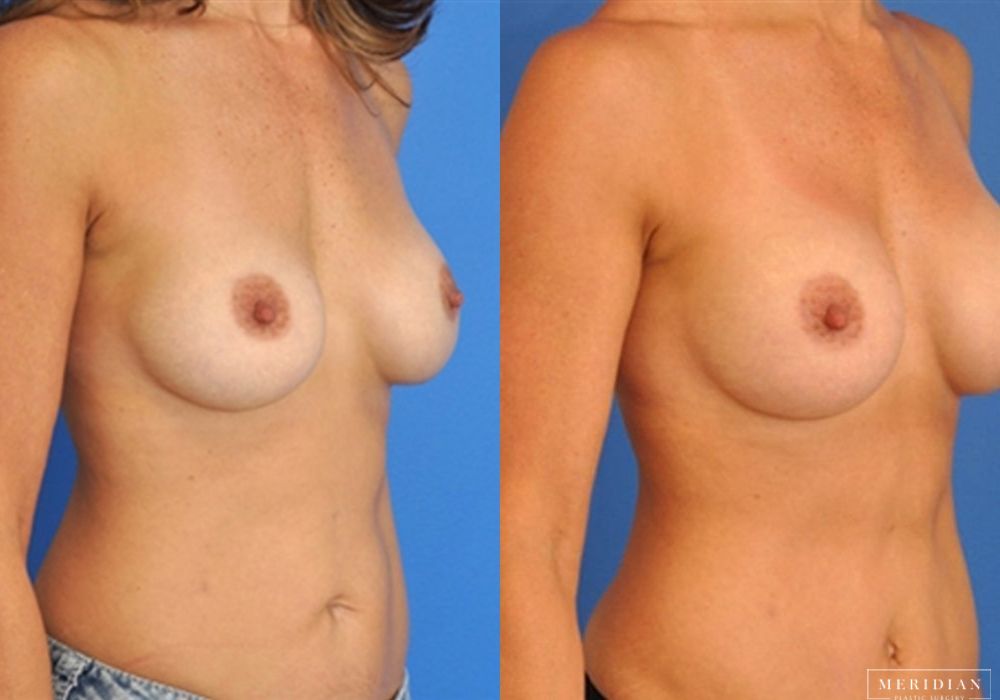 Breast Revision - Thumbnail 2