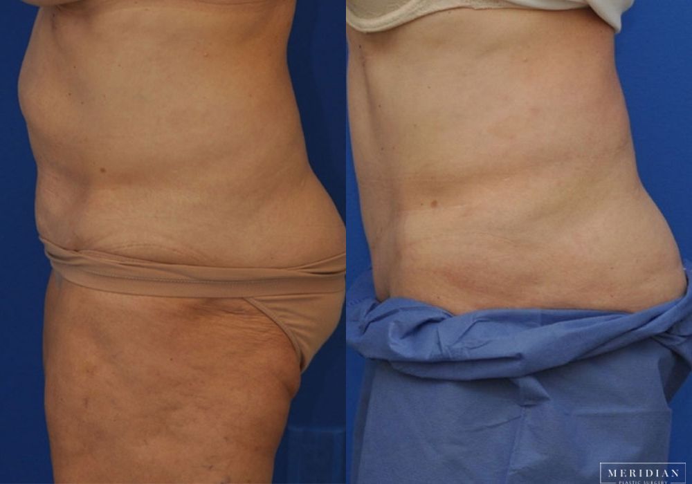 Tummy Tuck - Thumbnail 2