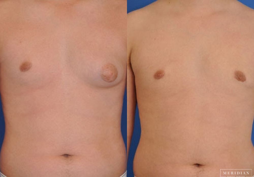 Gynecomastia - Case 7906