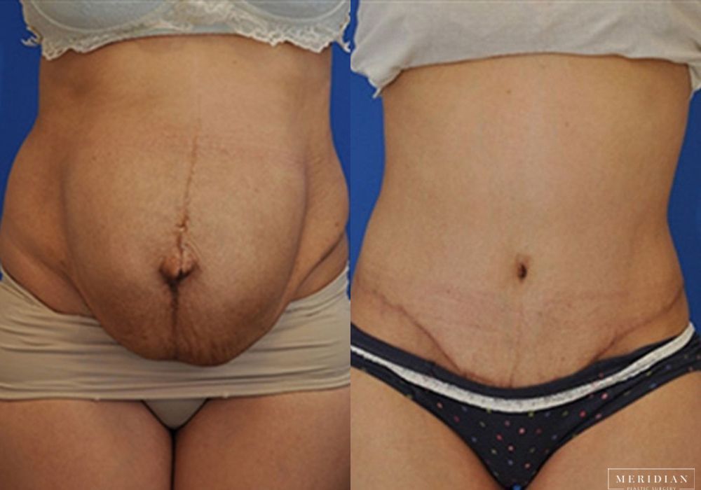 Before and after procedure result