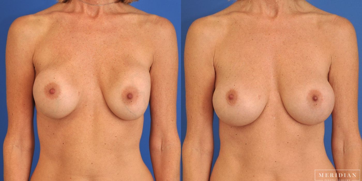 Before and after procedure result