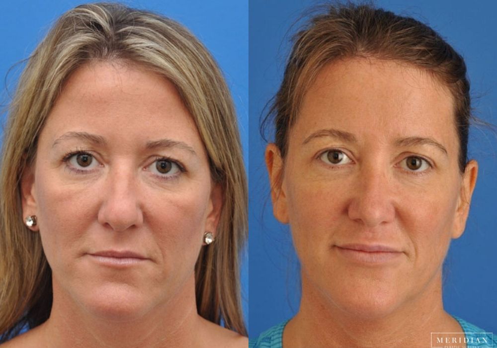 Injectables - Case 7955