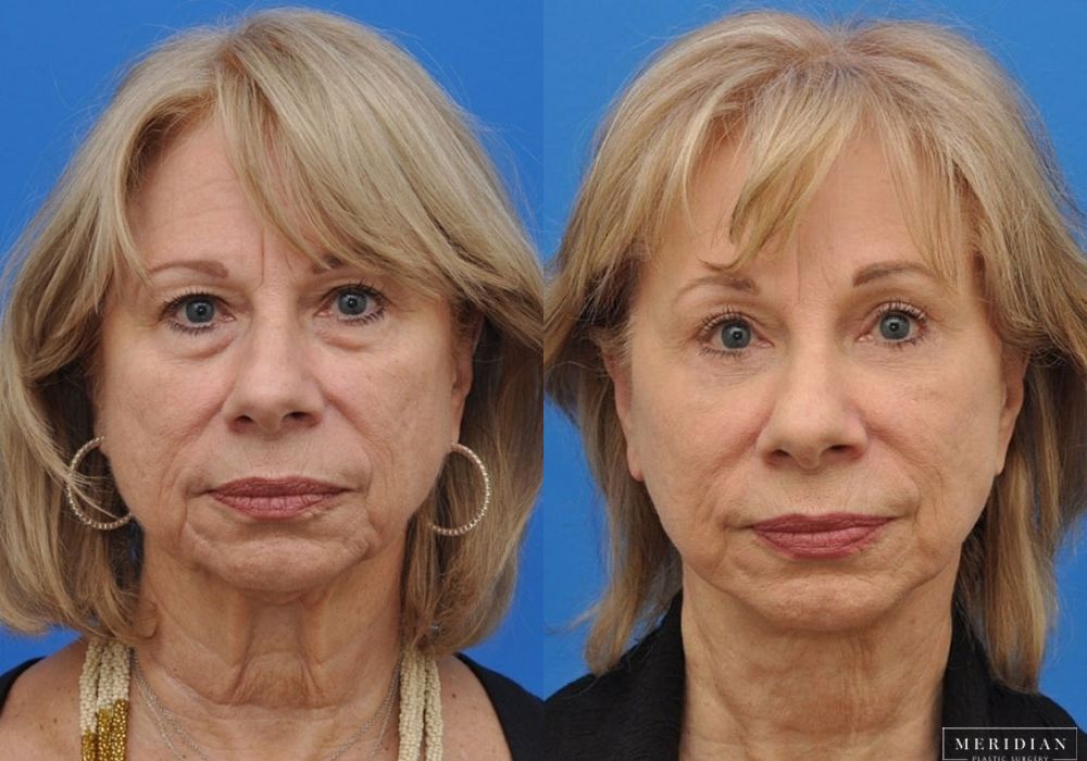 Lower Lid (Canthoplasty) - Case 7940