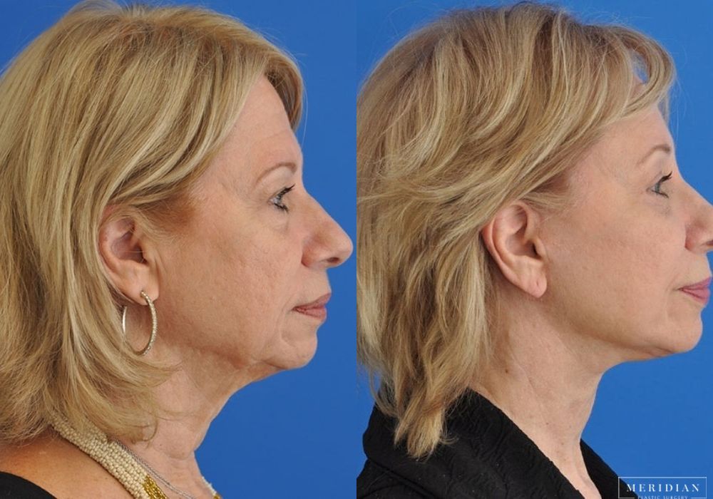 Neck Lift - Thumbnail 2
