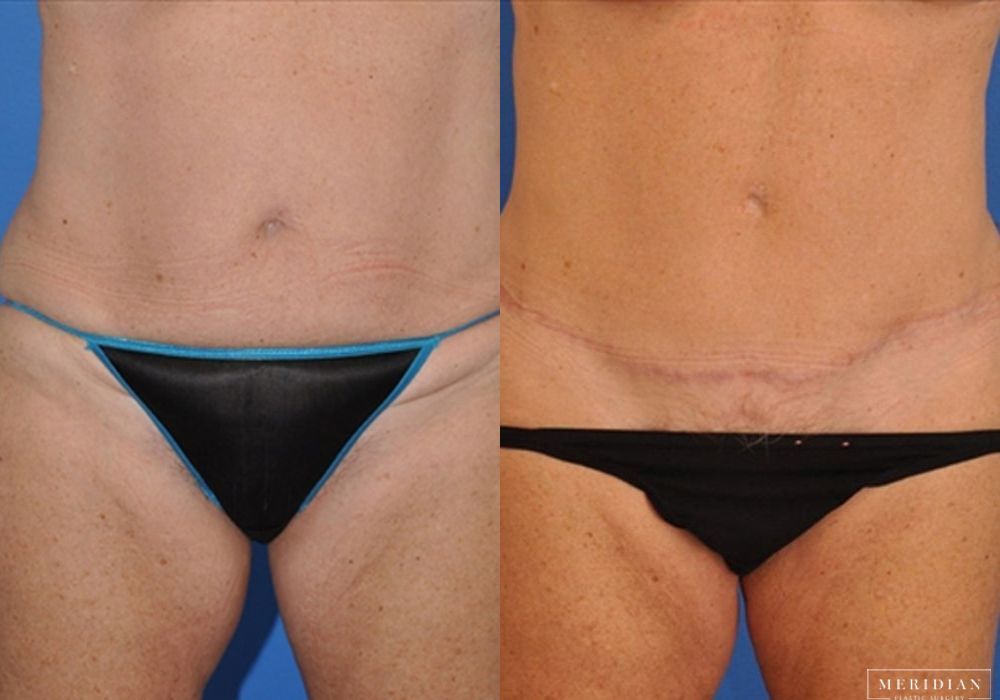 Tummy Tuck - Case 8000