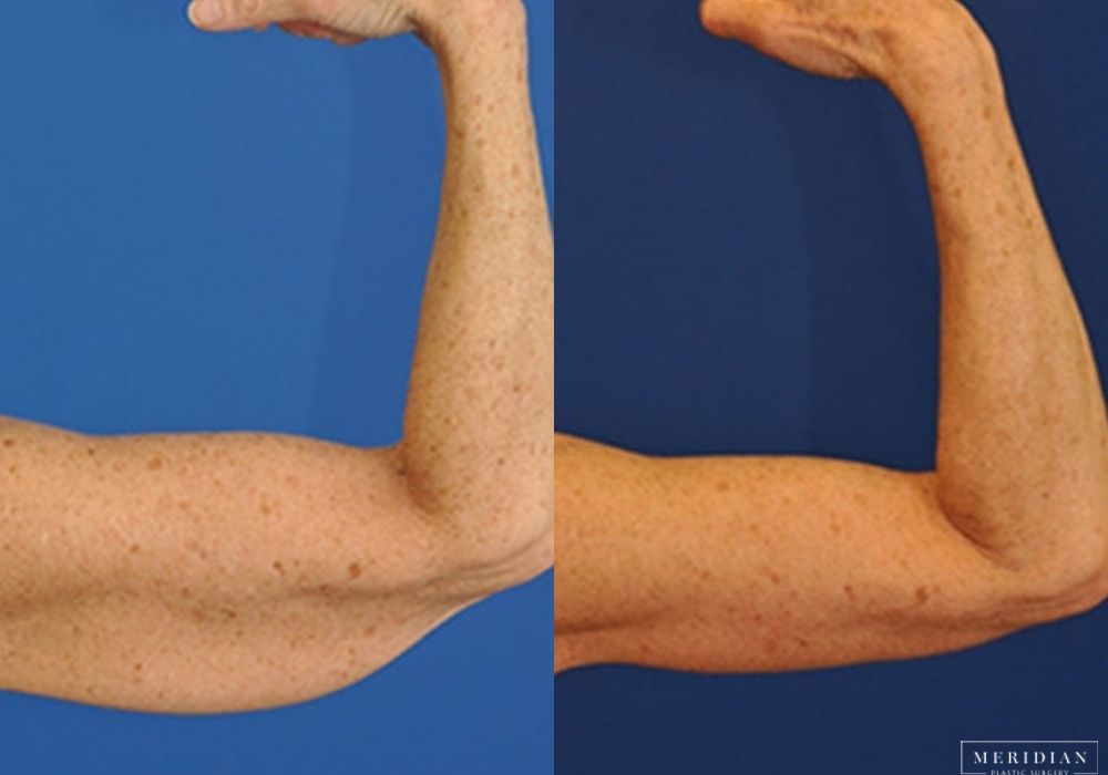 Arm Lift - Thumbnail 2
