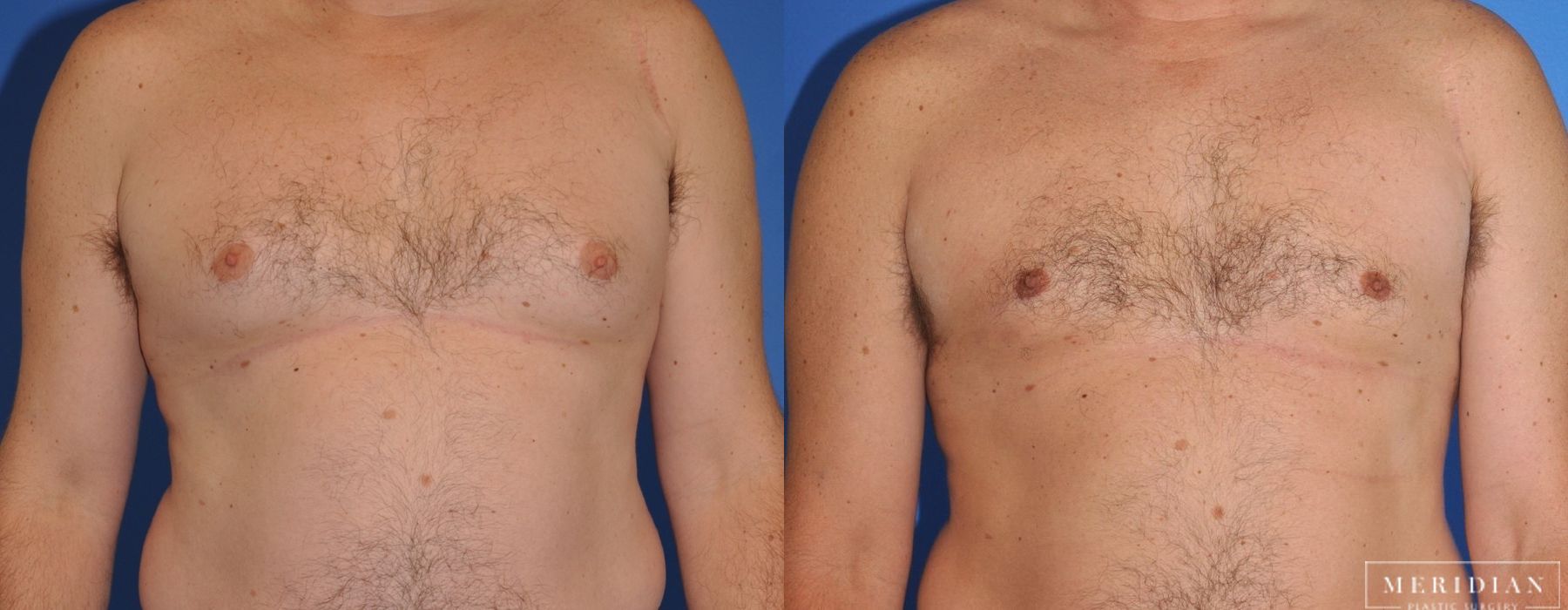 Gynecomastia - Case 7902