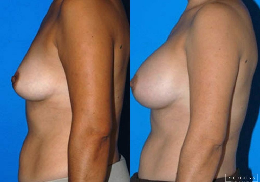 Breast Augmentation - Thumbnail 2