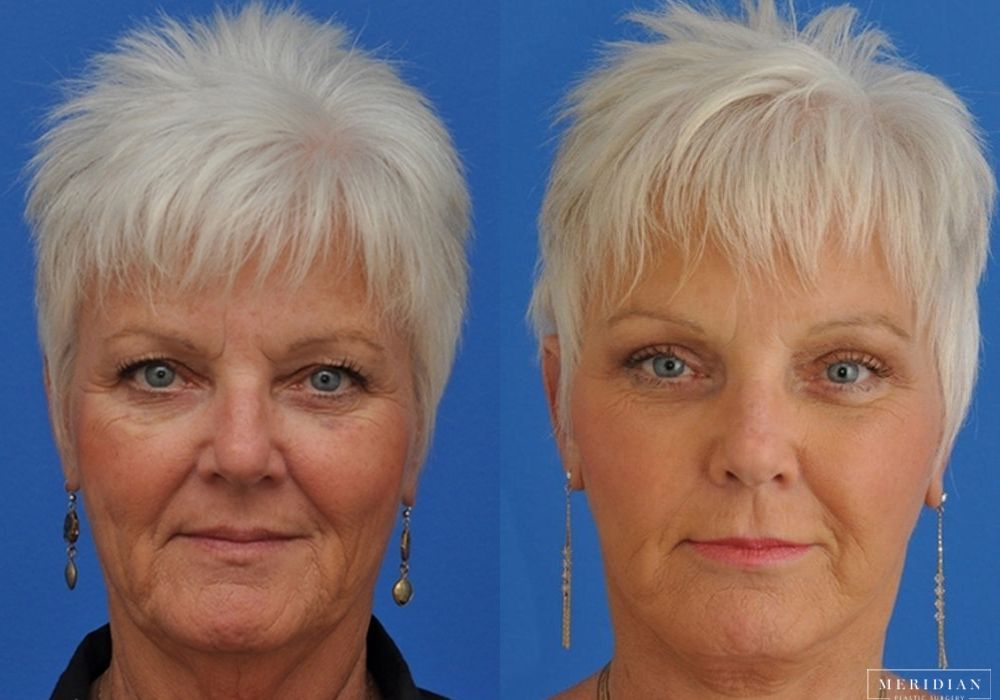 Eyelid Lift - Case 7923