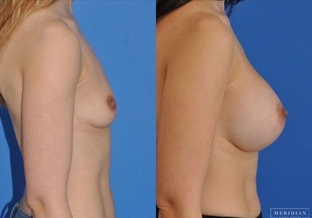 Breast Augmentation - Thumbnail 2