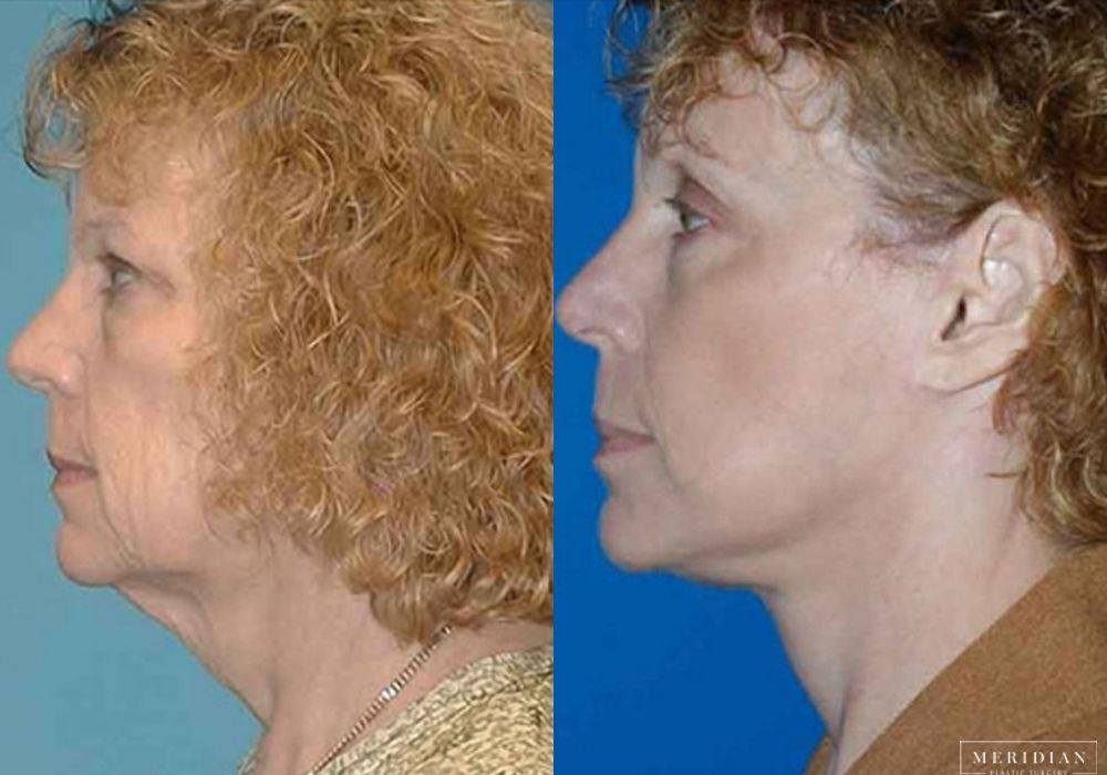 Brow Lift - Thumbnail 2