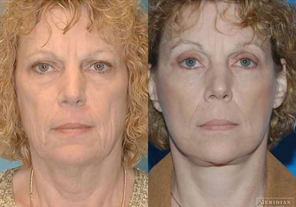 Eyelid Lift - Case 7919