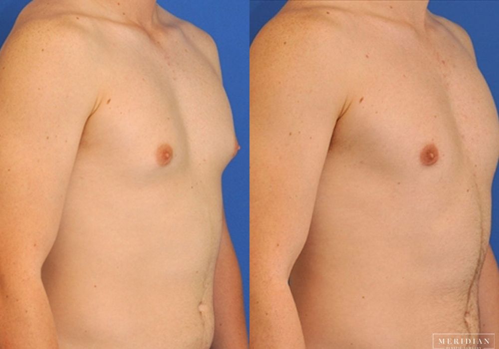 Gynecomastia - Thumbnail 2