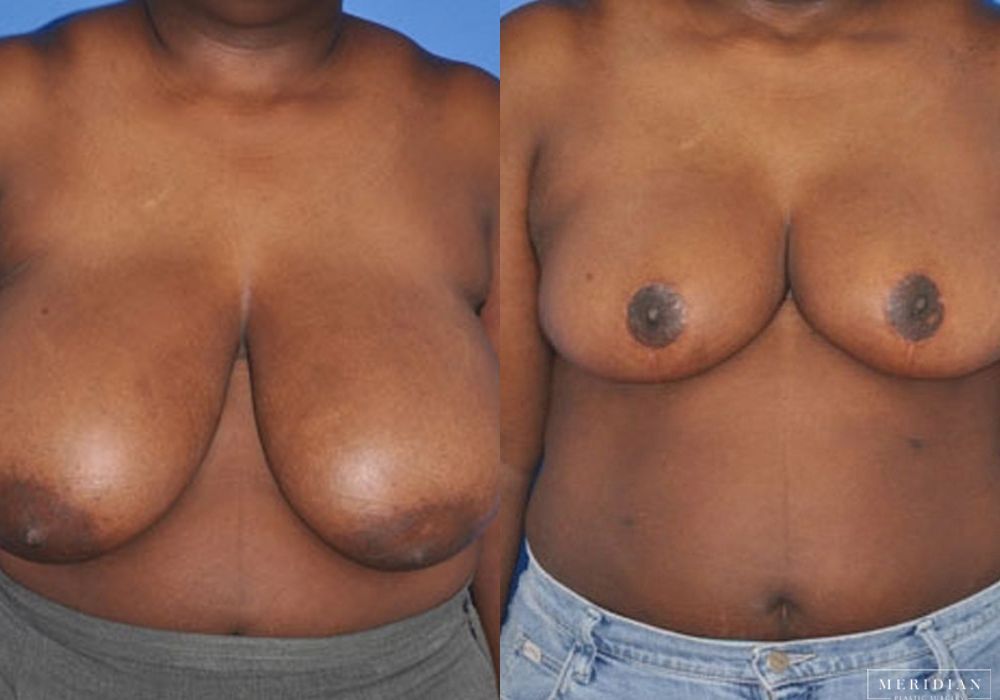 Breast Reduction - Case 7884