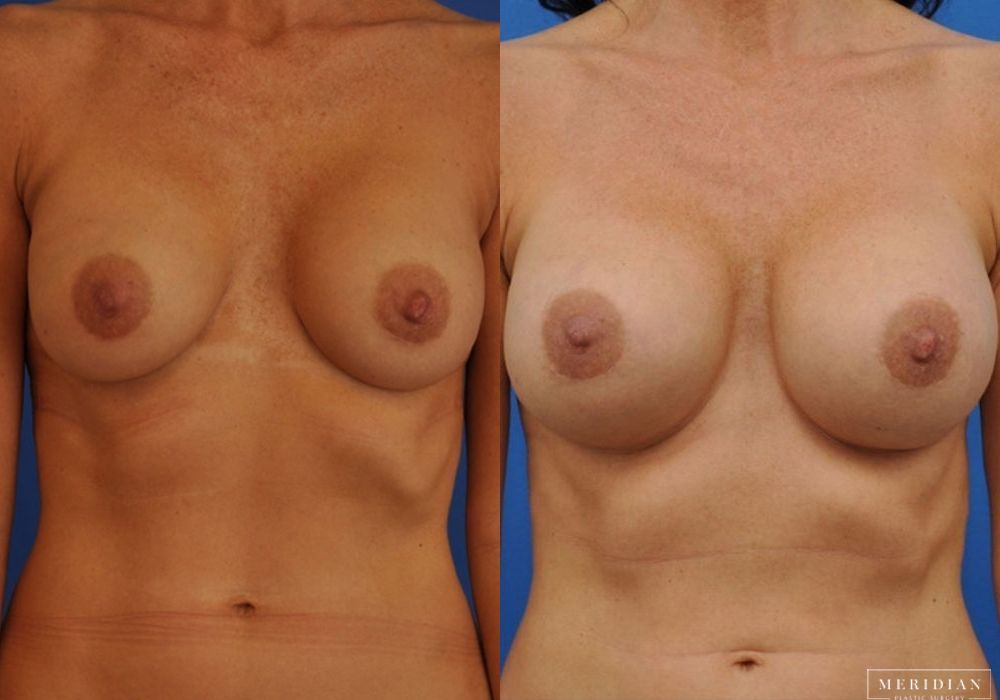 Breast Revision - Case 8084