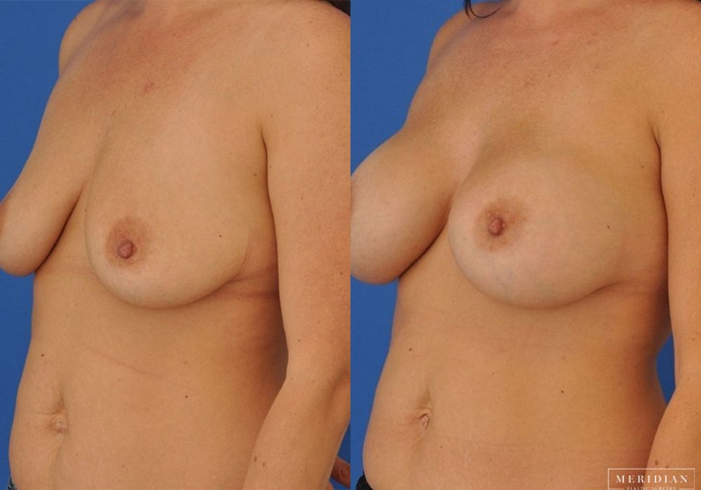 Breast Augmentation - Thumbnail 2