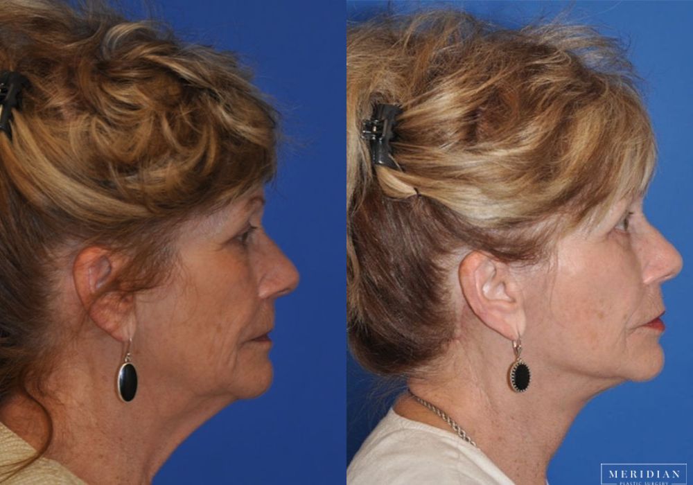 Neck Lift - Thumbnail 2