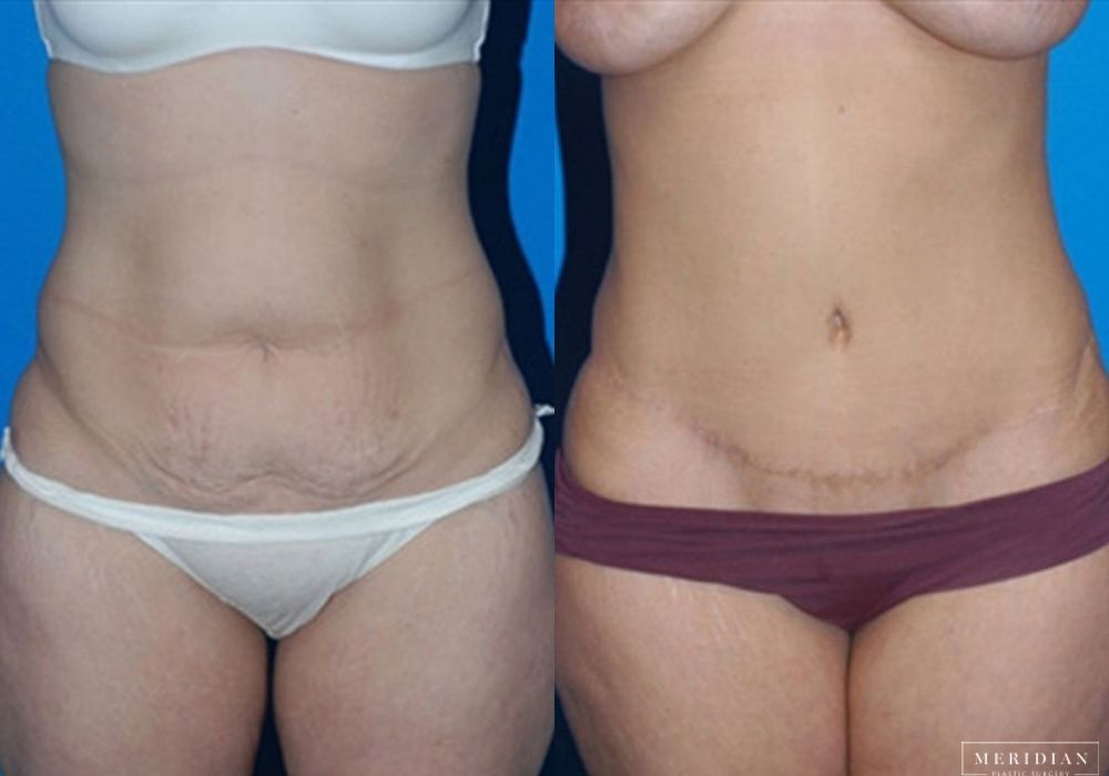 Body Contouring - Case 7968
