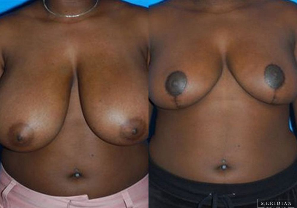 Breast Reduction - Case 7878