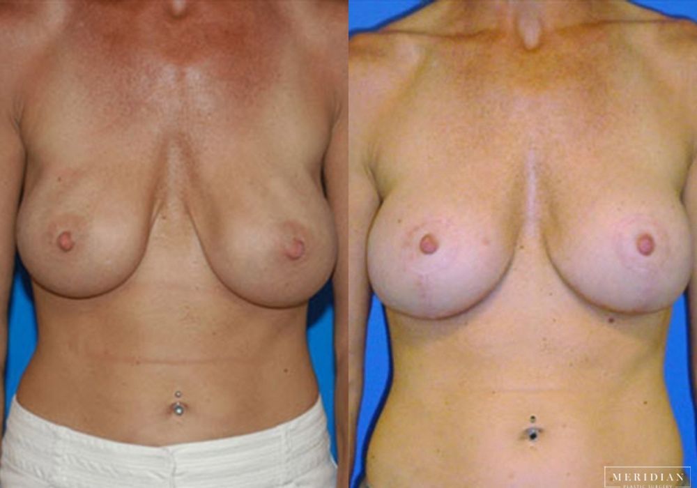 Breast Lift - Case 7874
