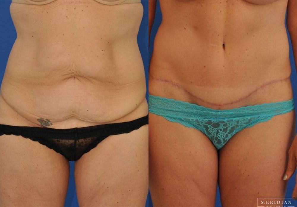 Body Contouring - Thumbnail 2