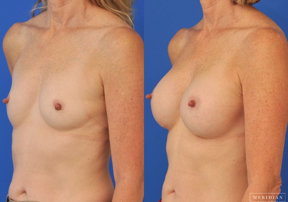 Breast Augmentation - Thumbnail 2