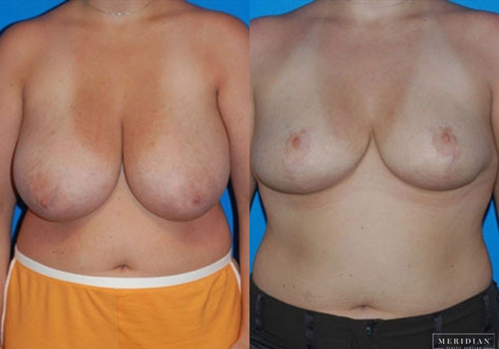 Breast Reduction - Case 7877