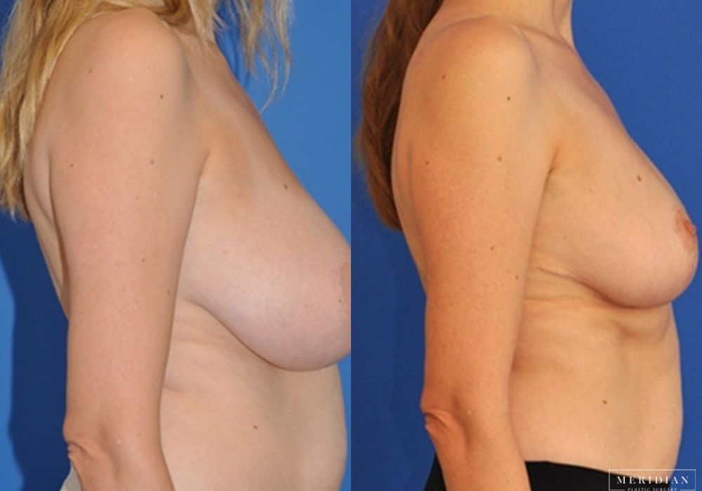 Breast Lift - Thumbnail 2