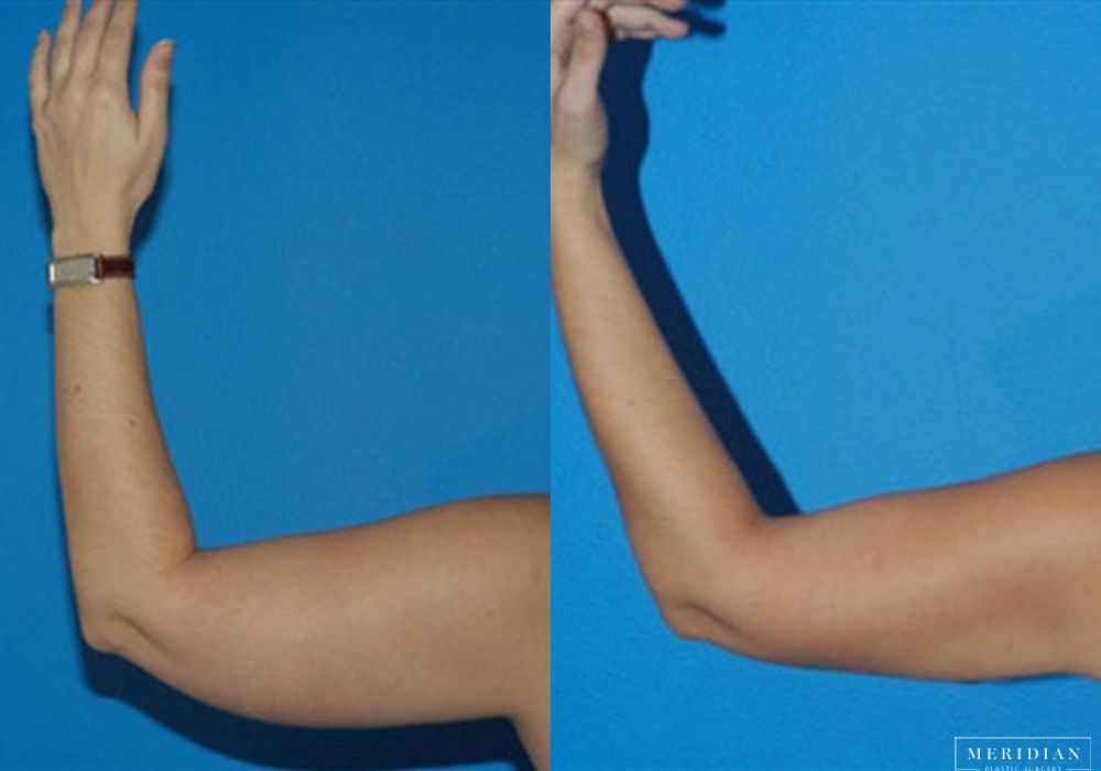 Body Contouring - Case 7977