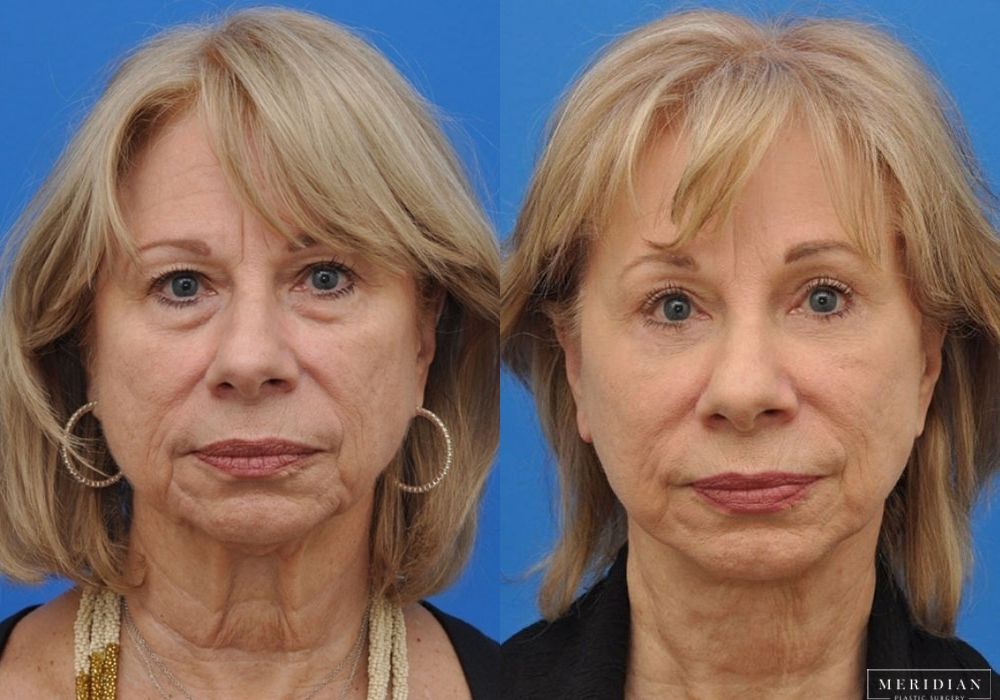 Brow Lift - Case 7915