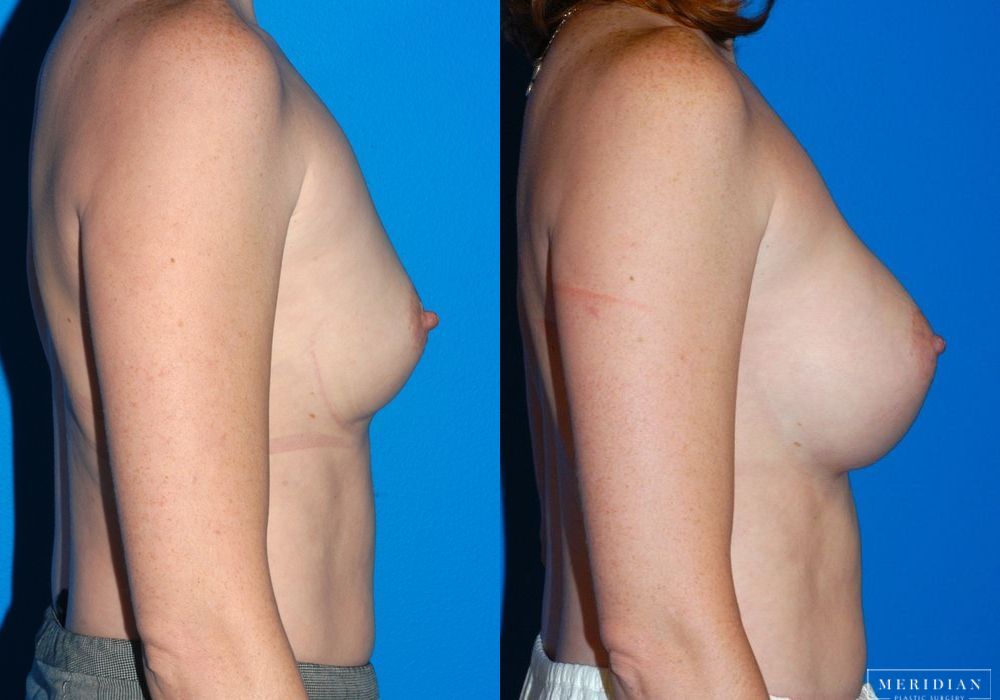Breast Augmentation - Thumbnail 3