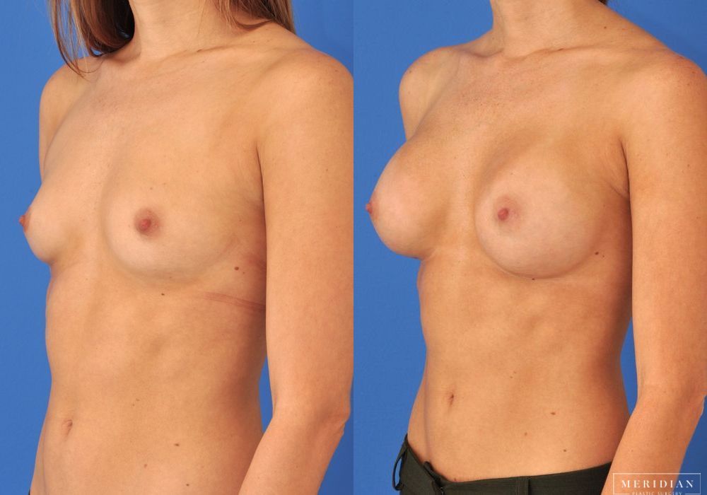 Breast Augmentation - Thumbnail 2