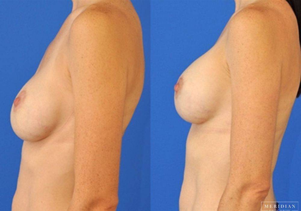 Breast Revision - Thumbnail 2