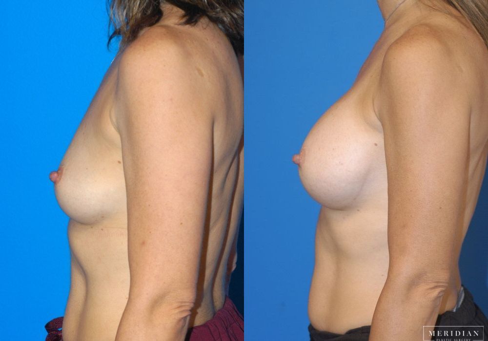Breast Augmentation - Thumbnail 3