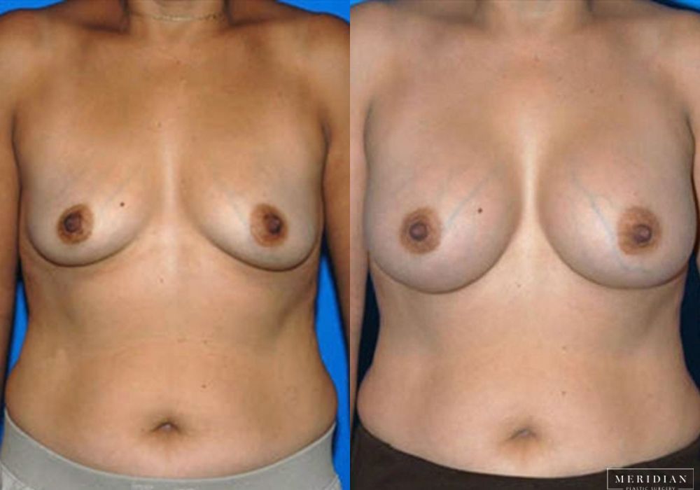 Breast Augmentation - Case 8037