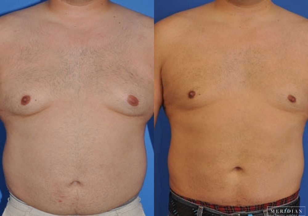 Gynecomastia - Case 7907