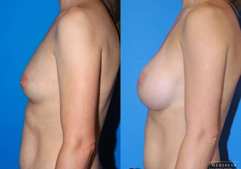 Breast Augmentation - Thumbnail 3
